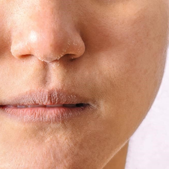 closeup of an allergic woman with eczema dry nose and lips in winter